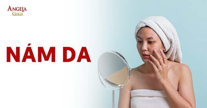 Nám da là gì? Nguyên nhân, dấu hiệu và cách điều trị