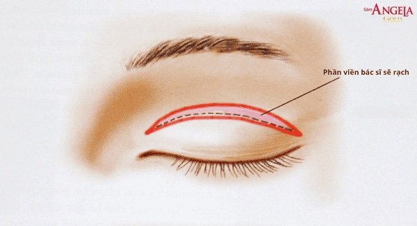Phẫu thuật mí mắt sẽ có những nguy cơ gì?