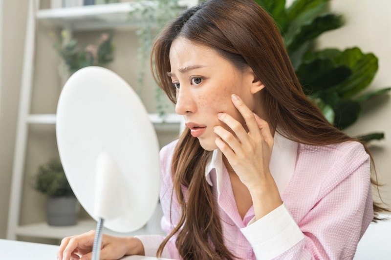 Sự thay đổi đột ngột estrogen trước và sau khi sinh có thể dẫn đến hiện tượng sạm nám, tàn nhang.