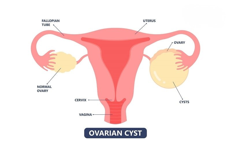 U nang buồng trứng là các khối u chứa dịch, có thể chèn ép cơ quan gây đau bụng dưới