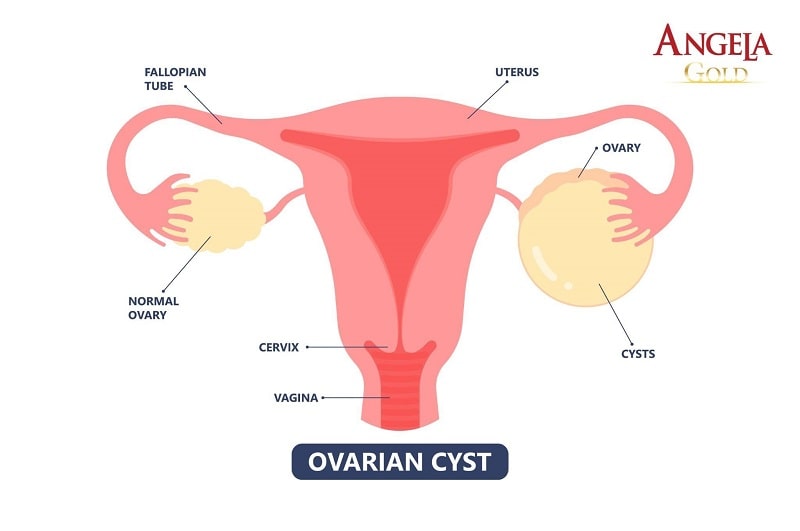 Tiền mãn kinh có bị đau bụng không