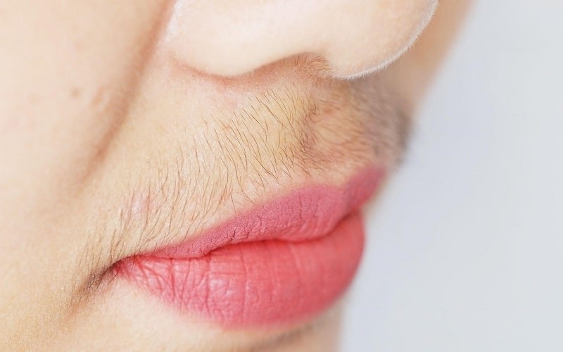 Testosterone làm gián đoạn chu kỳ rụng trứng, gây mụn, rậm lông, giọng nói trầm ở nữ