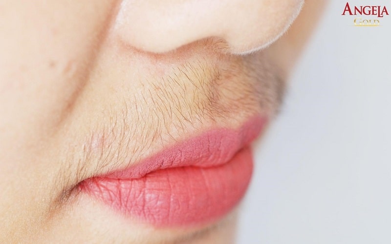 Nồng độ Testosterone cao ở phụ nữ