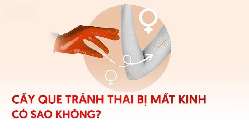Cấy que tránh thai bị mất kinh