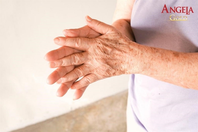 Xuất hiện các đốm đồi mồi hoặc nốt sần