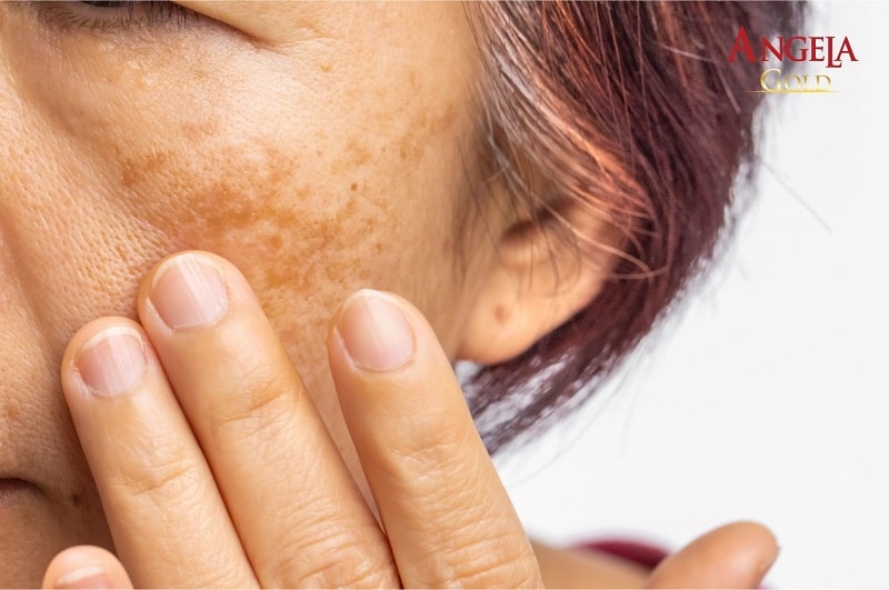 Nám da ảnh hưởng gì đến cuộc sống?