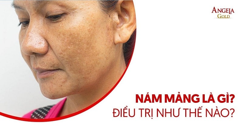 Nám mảng là gì? Nguyên nhân, dấu hiệu và cách ngăn ngừa