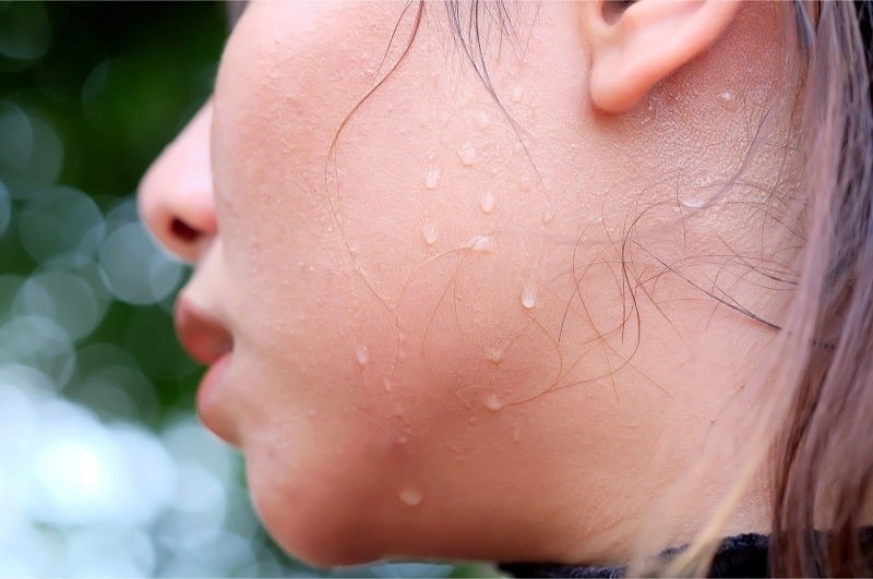 Tiết nhiều mồ hôi ở mặt