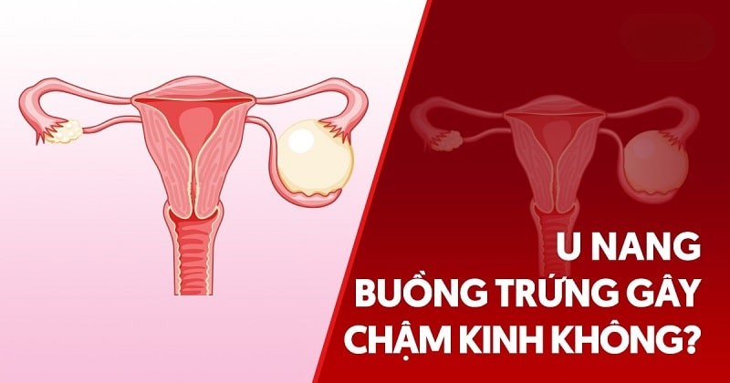 U nang buồng trứng gây chậm kinh không? Phòng ngừa như thế nào?