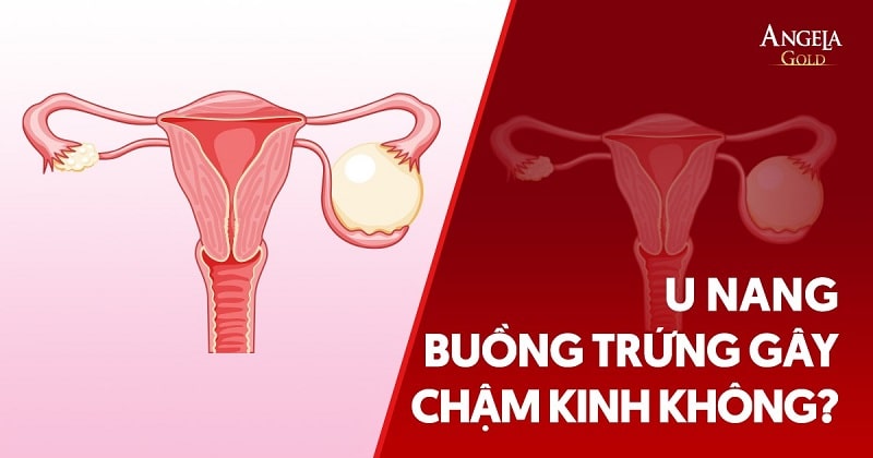 U nang buồng trứng gây chậm kinh không? Phòng ngừa như thế nào?