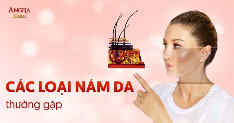 Các loại nám da thường gặp: Phân biệt đặc điểm 3 loại phổ biến