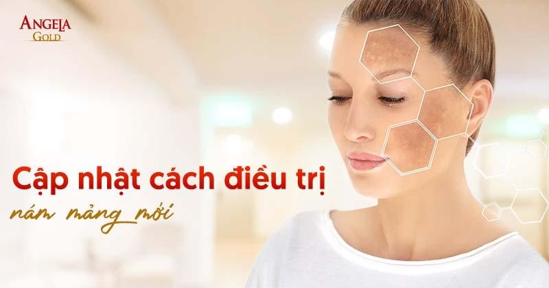 14 cách điều trị nám mảng hiệu quả tại nhà được chuyên gia tư vấn