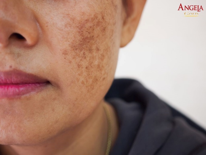 Da bị nám chân đinh liệu có chữa được không?
