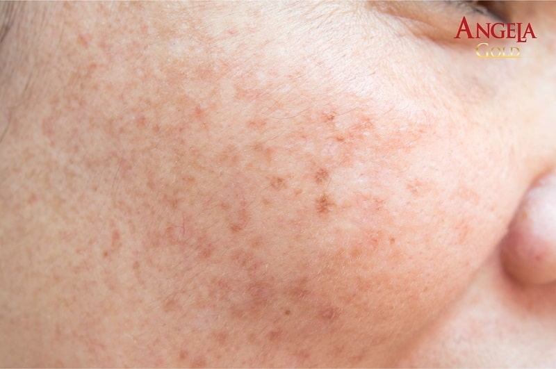Da bị nám chân sâu có chữa được không?