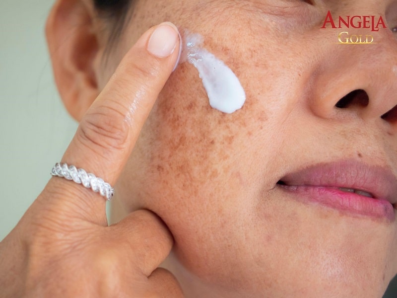 Dùng thuốc, kem thoa trị nám mảng