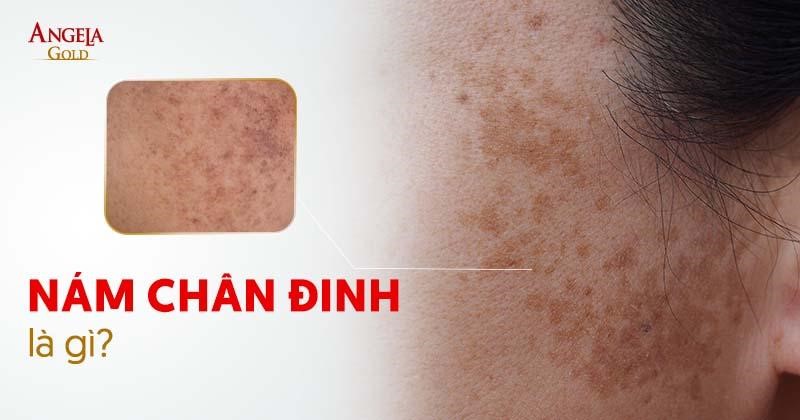 Nám chân đinh là gì? Nguyên nhân, dấu hiệu và cách điều trị