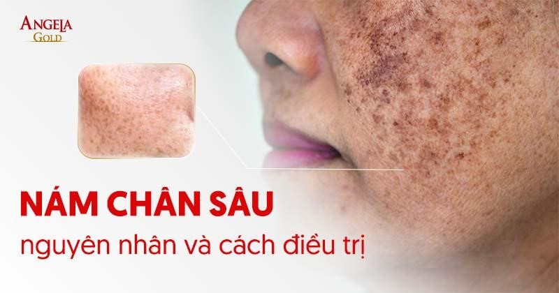Nám chân sâu là gì? Nguyên nhân, dấu hiệu và cách điều trị
