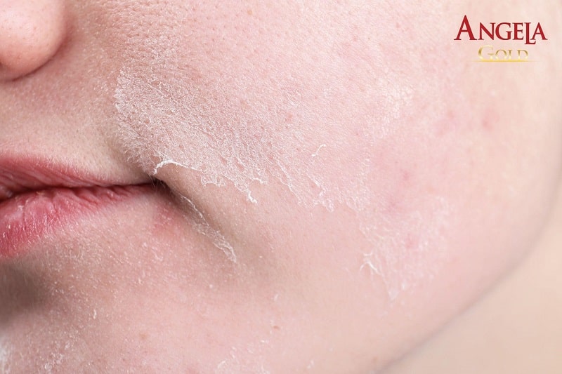 Peel da điều trị nám mảng