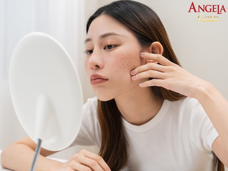 Bị nám da vùng má có trị hết không?