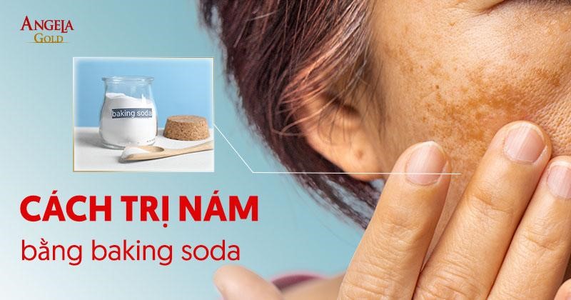 7 cách trị nám bằng baking soda an toàn đơn giản tại nhà