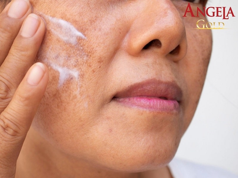 Dùng kem đặc trị nám da