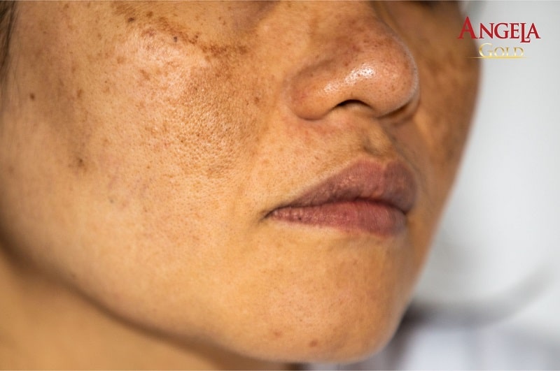 hình ảnh nám hỗn hợp 1