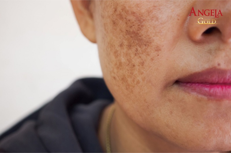 hình ảnh nám hỗn hợp 2