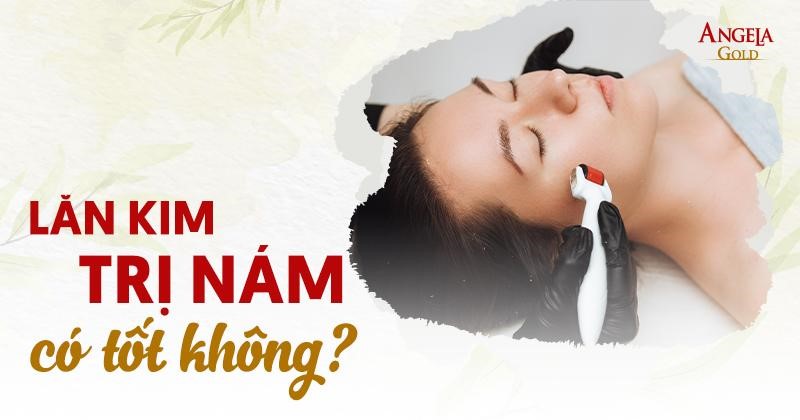 Cách lăn kim trị nám có tốt không? Quy trình và tác dụng