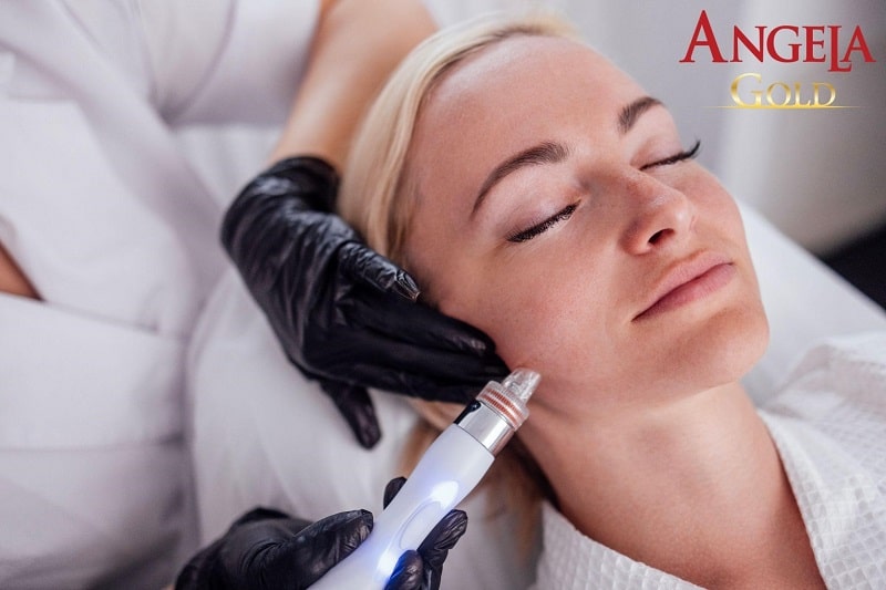 Laser trị nám