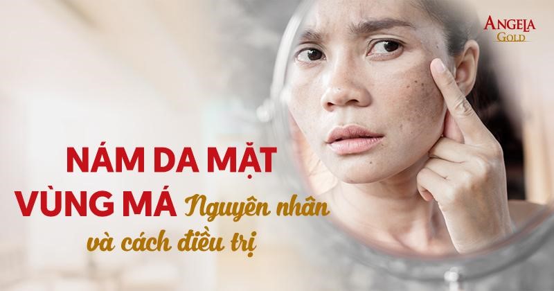 Nám da mặt vùng má 2 bên: Nguyên nhân, dấu hiệu và cách điều trị