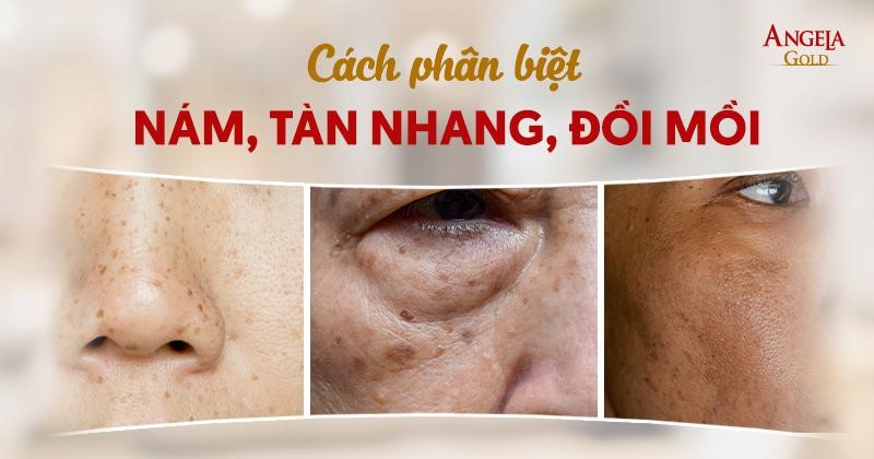 Cách phân biệt nám tàn nhang đồi mồi đơn giản bạn cần chú ý