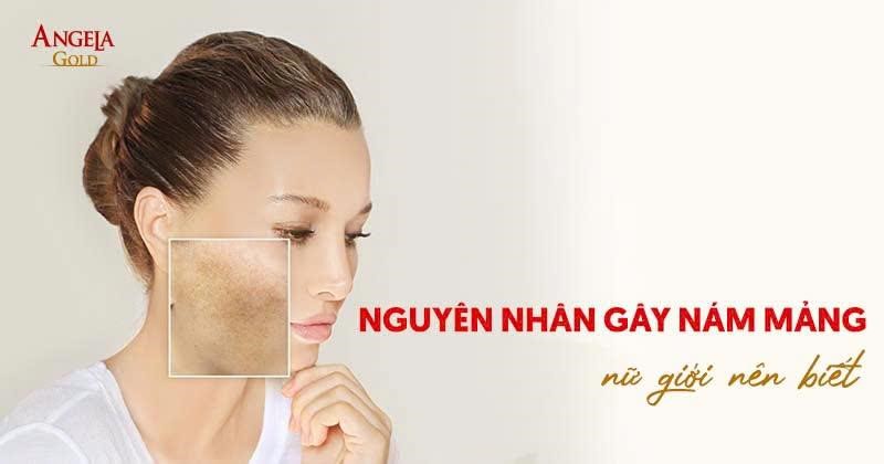 9 nguyên nhân gây nám mảng da mặt phổ biến hiện nay