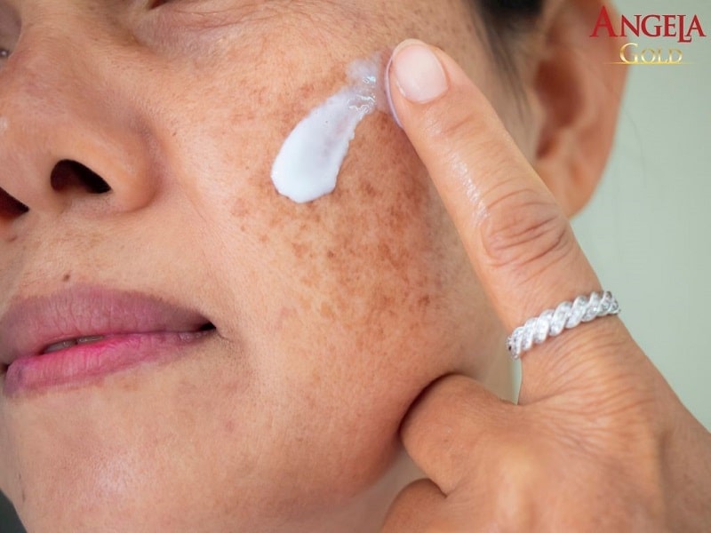 Sử dụng kem bôi điều trị nám lâu năm