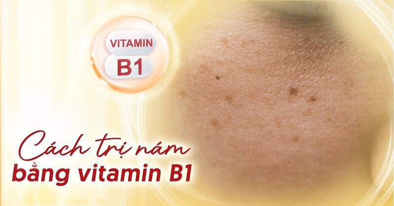 Top 6 cách trị nám bằng vitamin B1 được chuyên gia khuyên dùng