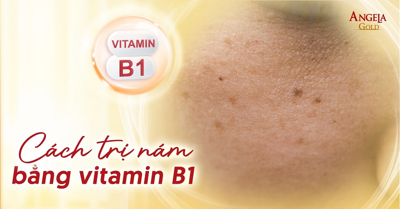 Top 6 cách trị nám bằng vitamin B1 được chuyên gia khuyên dùng