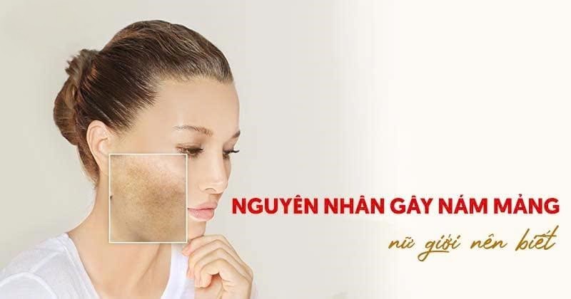 9 nguyên nhân gây nám mảng da mặt phổ biến hiện nay