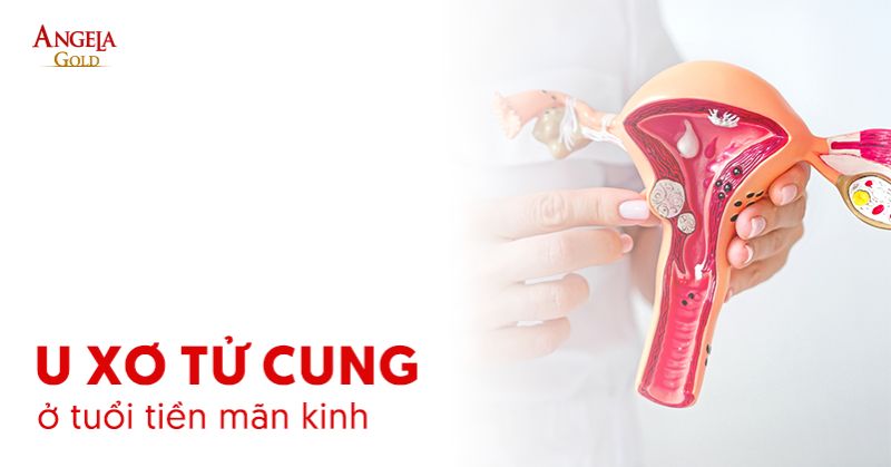 U xơ tử cung ở tuổi tiền mãn kinh: Nguyên nhân, cách điều trị