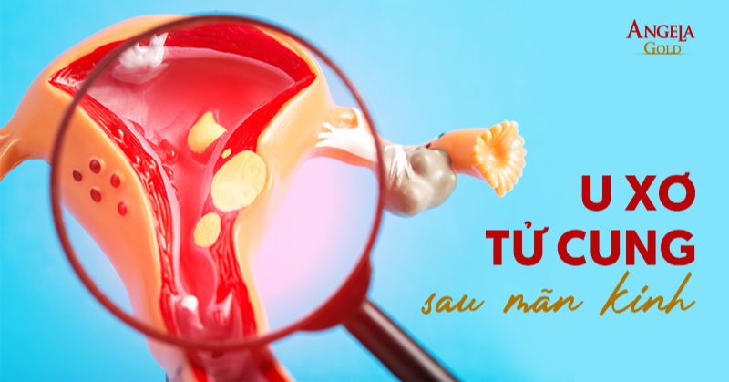 U xơ tử cung sau mãn kinh: Nguyên nhân và cách điều trị