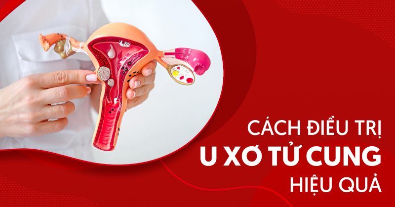 Các cách điều trị u xơ tử cung hiện nay chị em cần biết