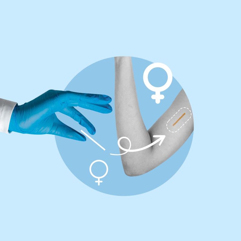 cấy que tránh thai