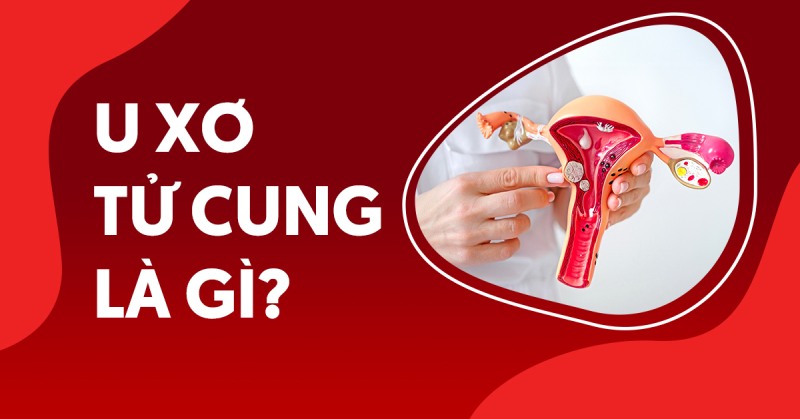 U xơ tử cung: Nguyên nhân, triệu chứng và chẩn đoán